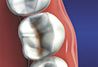 Decayed teeth require fillings to restore health of natural teeth Fillings