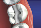 Decayed portions of teeth Decay