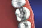Filling material that is shaped to match the look and feel of natural teeth Filling Material