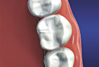 Natural looking materials are available to fill your teeth Materials that mimic the color of natural teeth