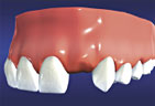 Dental Implants are prescribed to replace any missing teeth you may have Missing Teeth