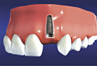 Implant posts are surgically placed where the tooth is missing Implant Post Placement