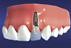 A customized crown is permanently cemented to the implant Customized crown or Bridge placed