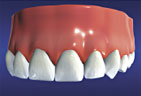 The natural beauty and function of the teeth is restored Dental Implant restored